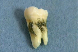 歯周病で縁下歯石のついた歯